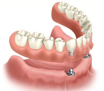 Implant Supported Dentures 